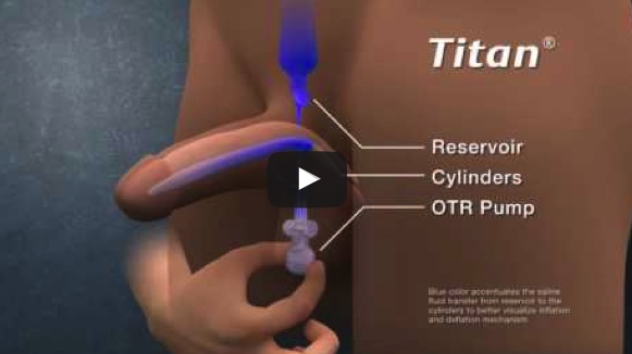 Dysfonction érectile VIDEOS