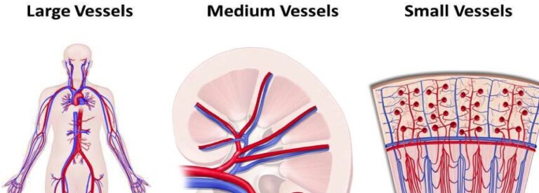 Journée F Luizy : CLASSIFICATION DES VASCULARITES.  ACTUALITES DE L’ARTERITE A CELLULES GEANTES