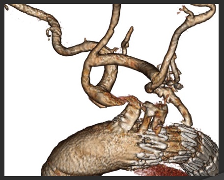 Journée F Luizy : Traitement chirurgical & endovasculaire des artériopathies non athéromateuses
