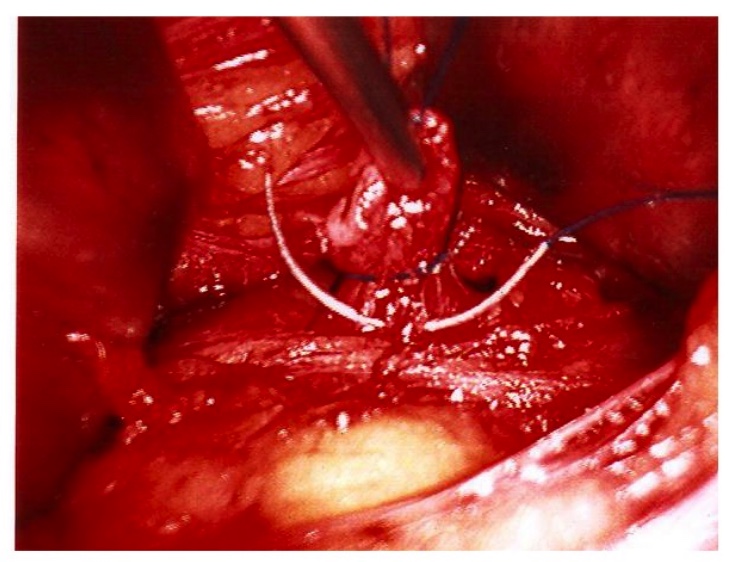 Traitement chirurgical des récidives variqueuses et place des thérapeutiques endoveineuses