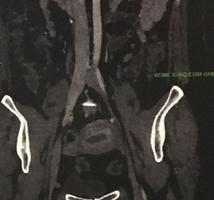 DPC : Les occlusions veineuses chroniques