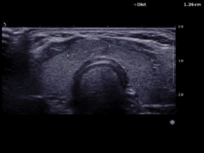 Nodules thyroïdes
