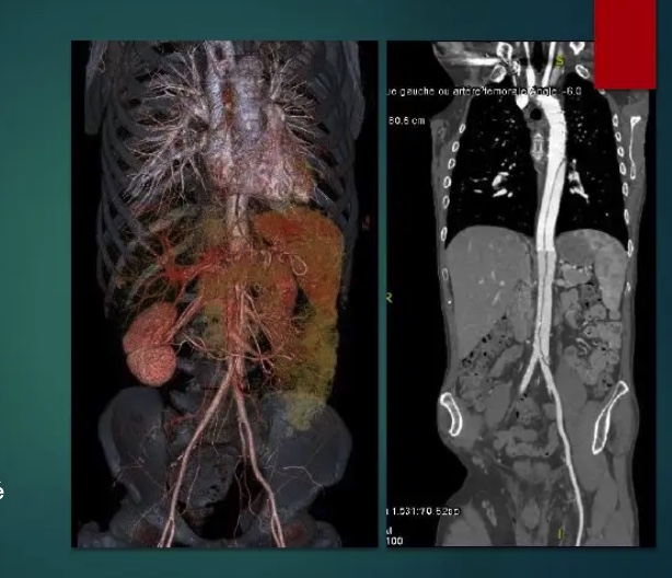 Imagerie des dissections aortiques
