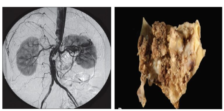 Calcifications Artérielles Mécanismes – Implications cliniques au niveau carotidien, implications thérapeutiques