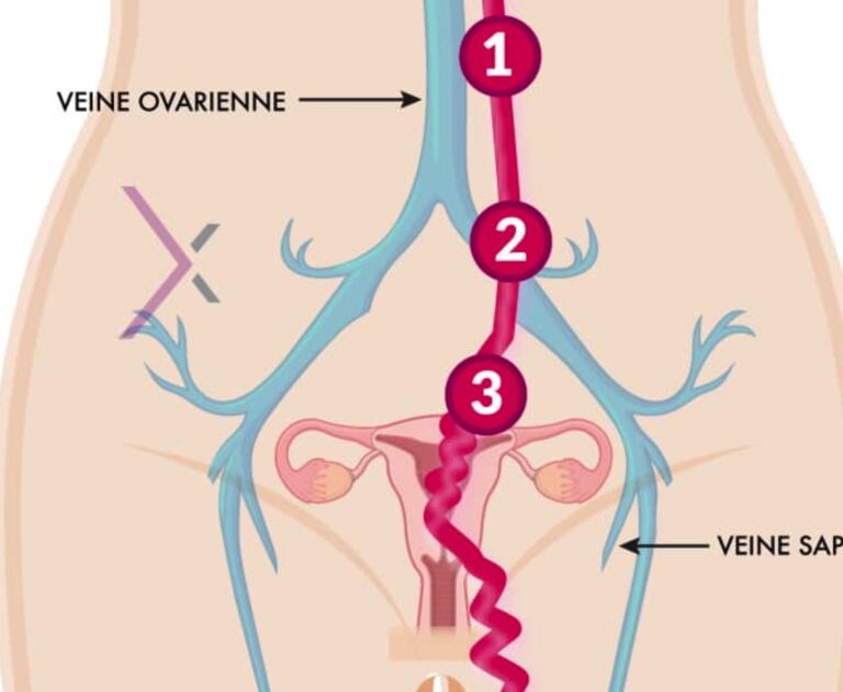 Diagnostic et prise en charge de la varicose pelvienne de la femme